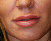 Feel Beautiful - Juvederm Ultra Plus 1 ml lip augmentation - After Photo